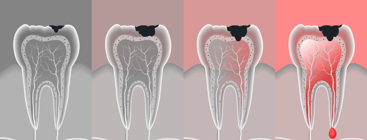 Does Milk Cause Tooth Decay In Toddlers