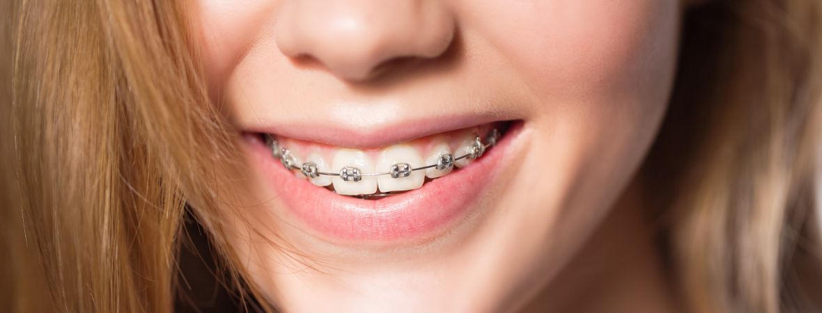 Teeth Whitening After Braces In Pleasanton Ca Gateway Dental Care